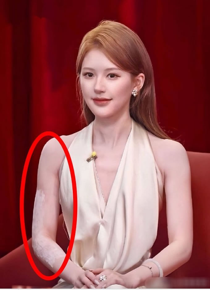 赵露思怎幺了？手臂现白色粉末 网忧是治「这种病」药物